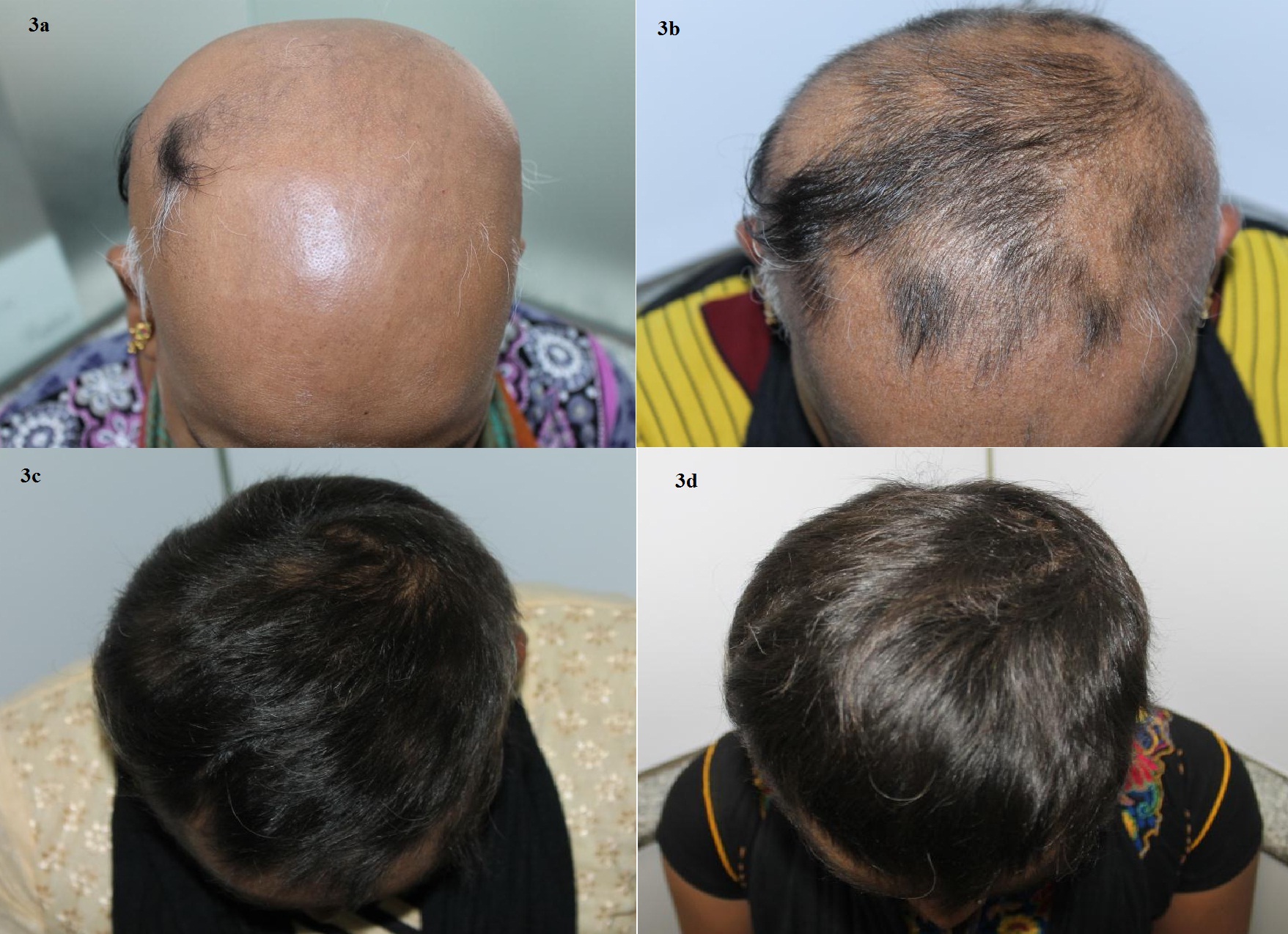 Triamcinolone Acetonide Mesotherapy in the Treatment of Recalcitrant